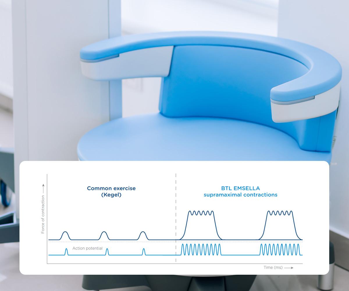How does BTL Emsella Work? | Pelvic Floor Treatment & Restoration | Alderley Edge, Cheshire