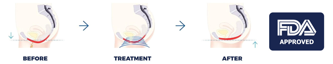 Treating Stress Incontinence with BTL Emsella